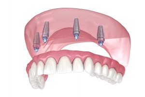 All-On-4 Dental Implants