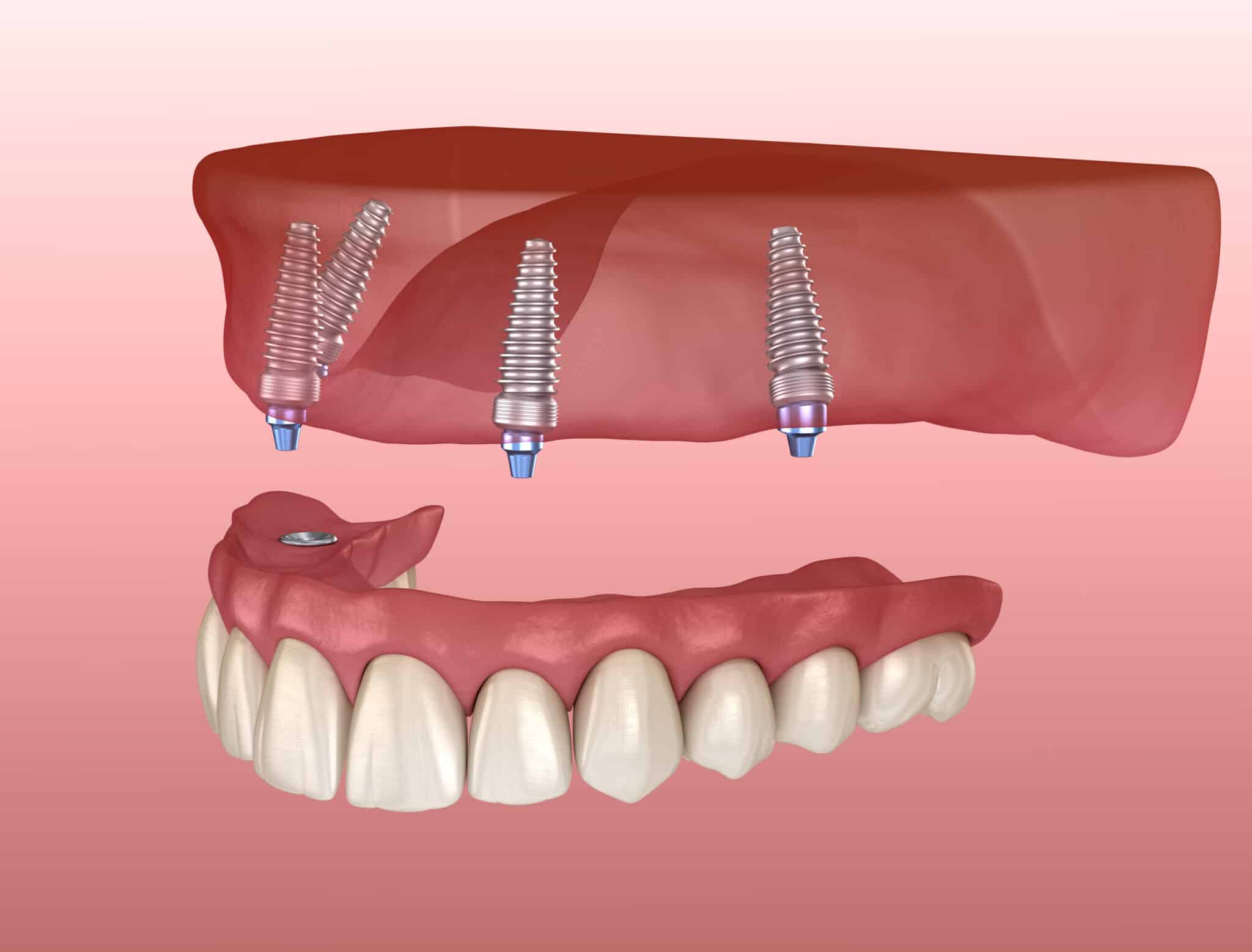 All On 4 Procedure, All On 4 Dental Implants